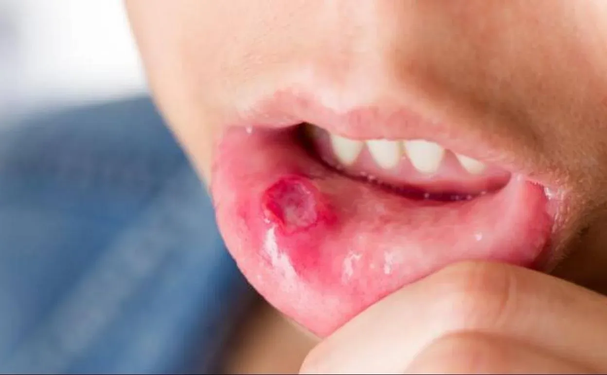 Bị nhiệt miệng: nguyên nhân và cách điều trị