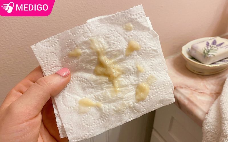 Khí hư màu vàng khi nào cần đi khám? Dấu hiệu không nên bỏ qua