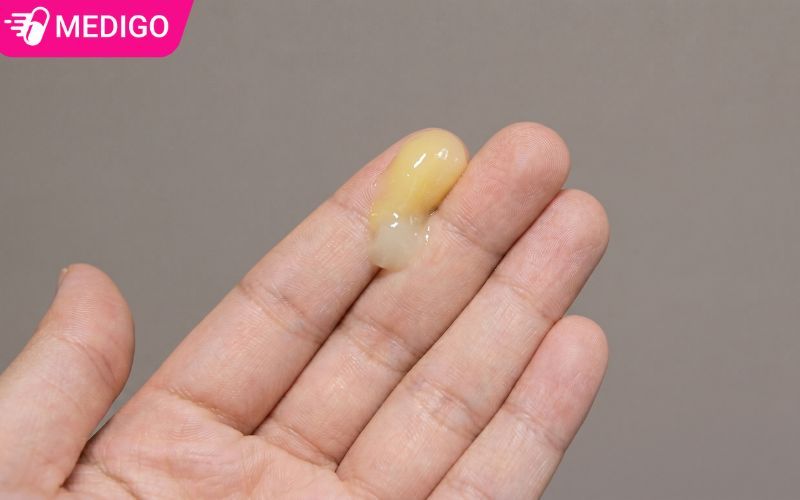 Khí hư màu vàng khi nào cần đi khám? Nhận biết đúng để tránh biến chứng