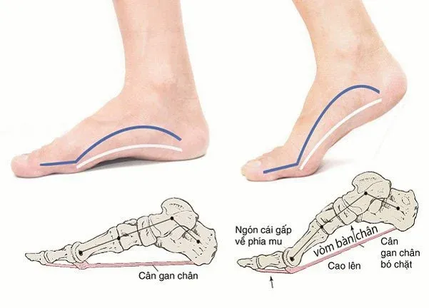 Bàn chân bẹt ở trẻ: Nguyên nhân và cách điều trị