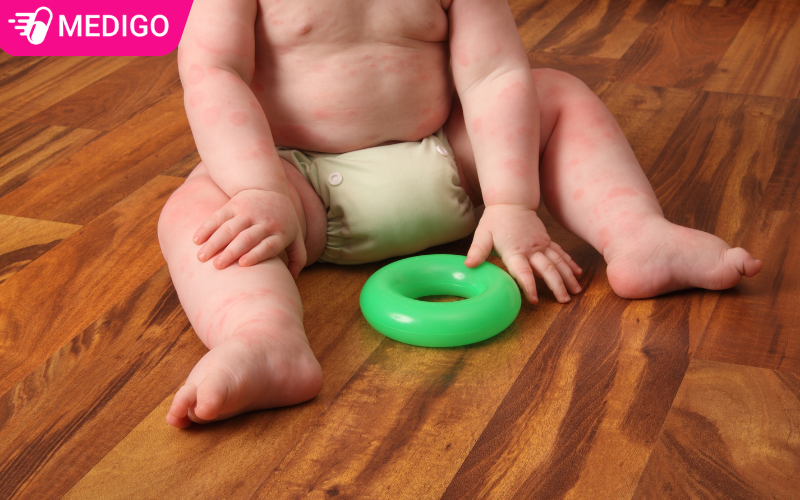 Xử lý mề đay ở trẻ đúng cách và an toàn tại nhà
