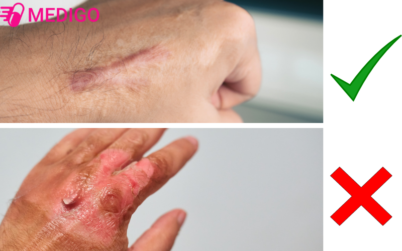 Su-dung-thuoc-tri-seo-khi-vung-da-bong-bat-dau-kho-lai-va-da-non-co-mau-hong