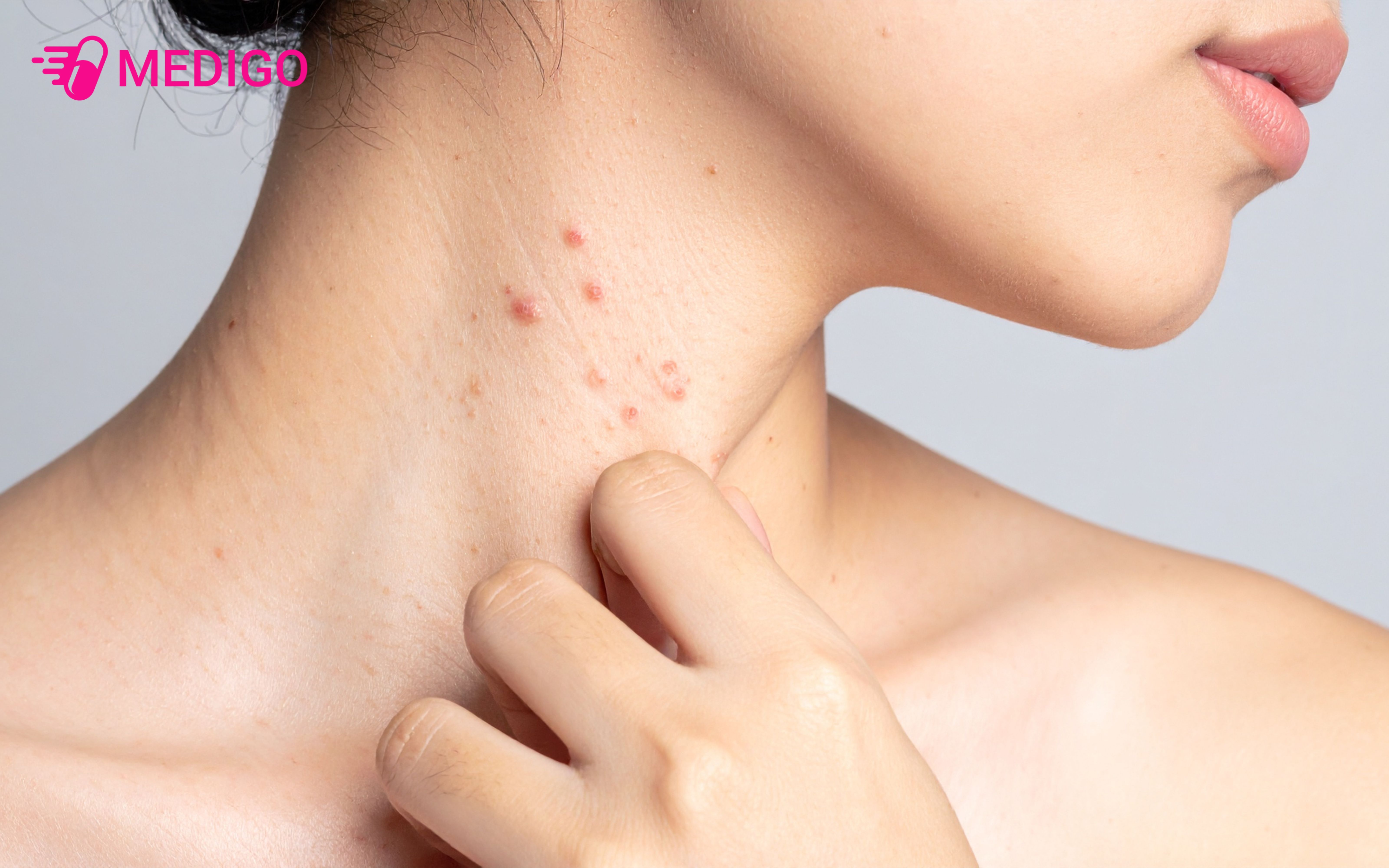 Cay-mat-quy-ho-tro-giam-man-ngua