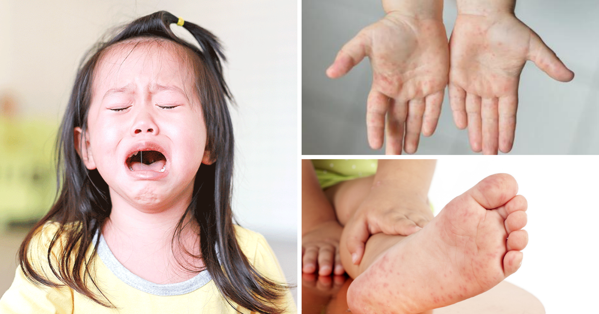 Bệnh tay chân miệng và những dấu hiệu nguy hiểm đến trẻ