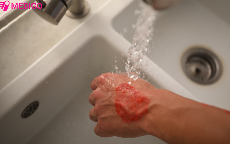 Lam-mat-vet-thuong-duoi-voi-nuoc-mat