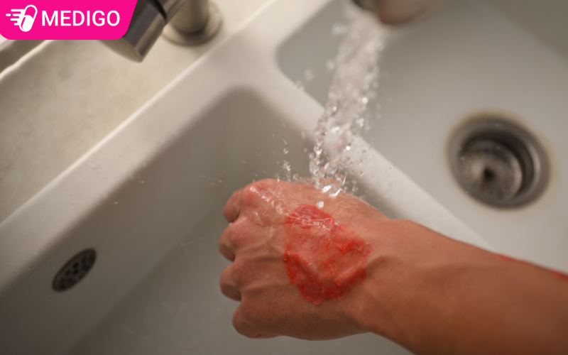 Xem ngay cách xử lý vết thương do bỏng đúng cách