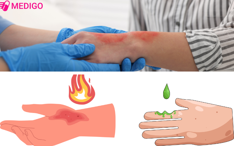 Nguyen-nhan-bi-bong-nhu-nuoc-soi-bong-nhiet-hoac-do-hoa-chat