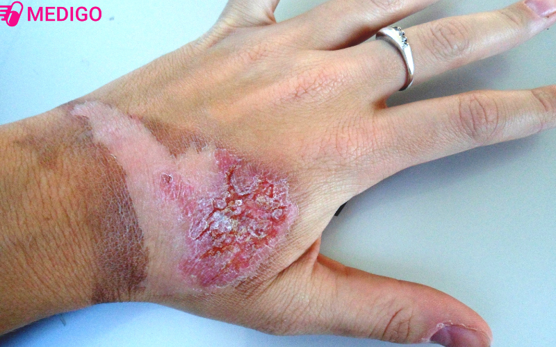 Viec-xu-ly-vet-bong-khong-dung-cach-co-the-dan-den-nhiem-trung-vet-thuong