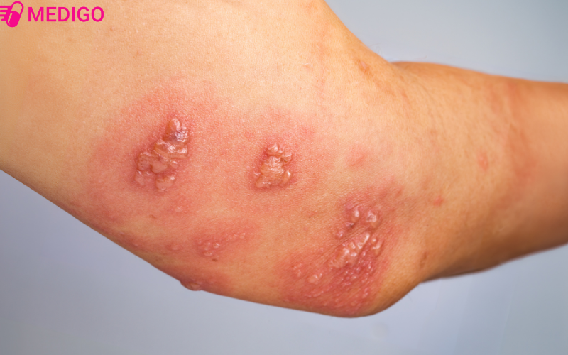 Bong-do-2-thuong-xuat-hien-bong-nuoc-tren-da