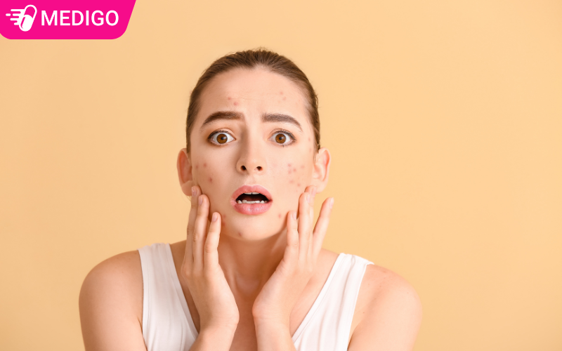 Trị mụn tại nhà đơn giản - 7 phương pháp mới nhất năm 2025