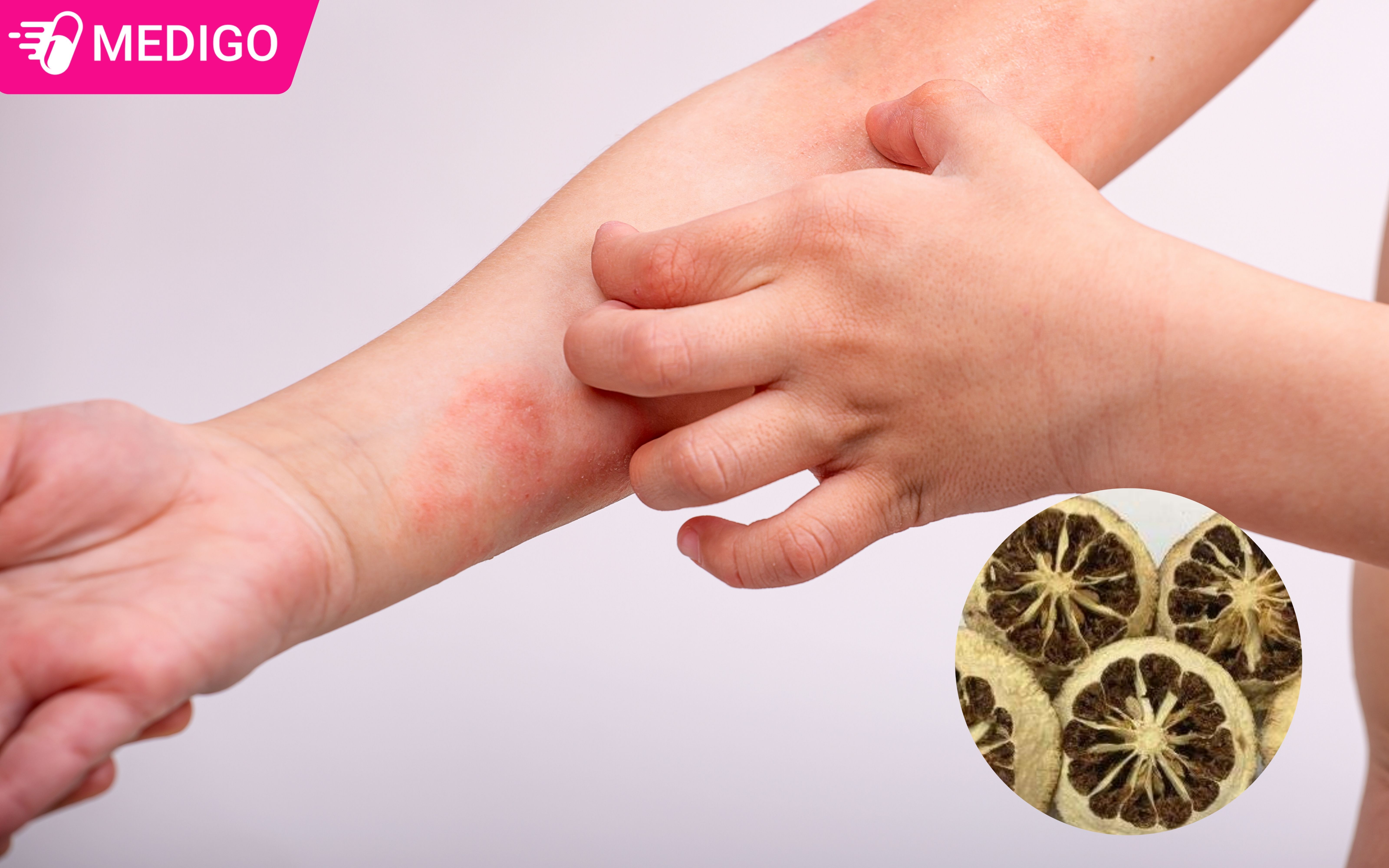 Chi-thuc-duoc-ghi-nhan-co-tac-dung-trong-dieu-tri-di-ung