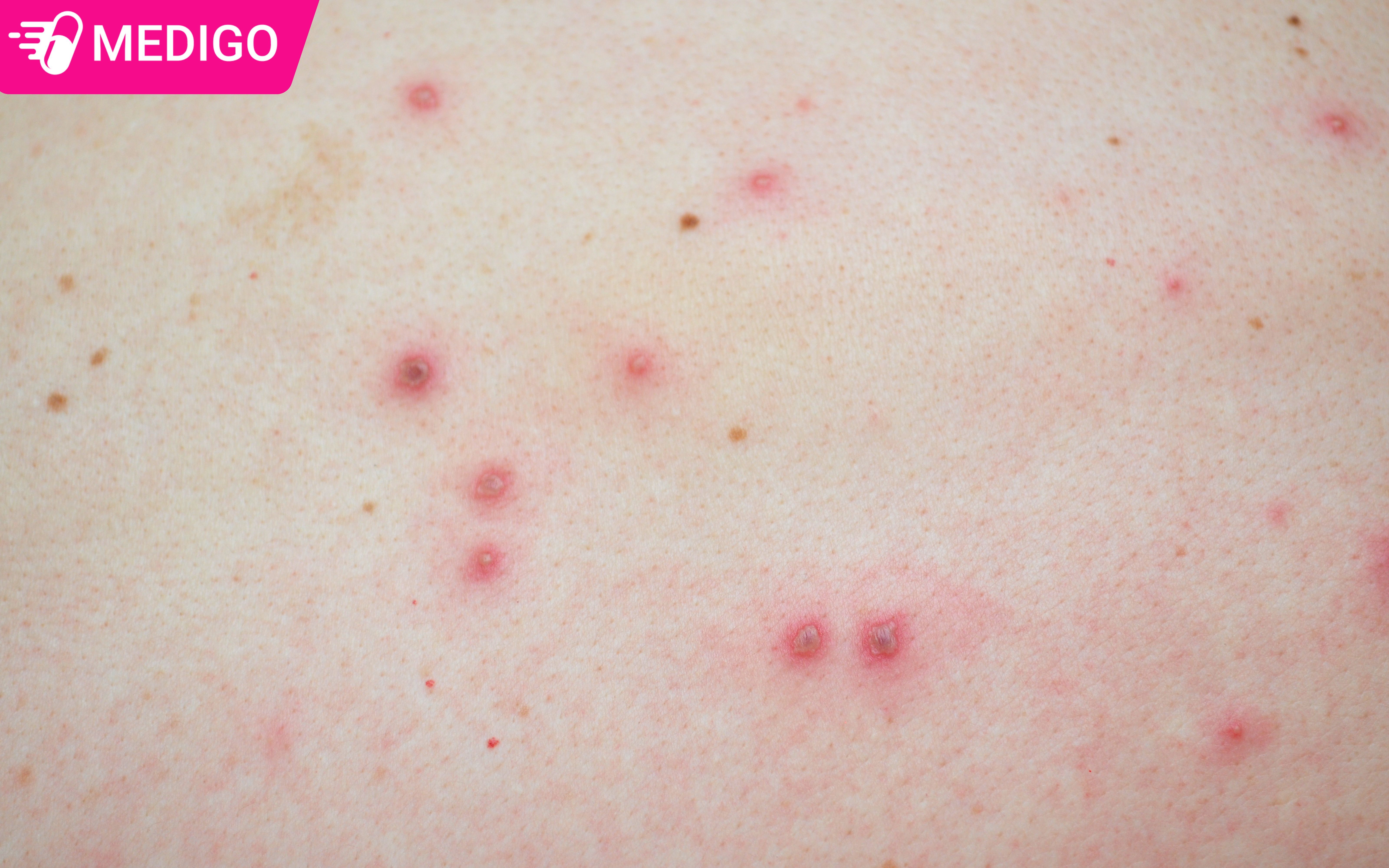 Hinh-anh-khi-benh-dau-mua