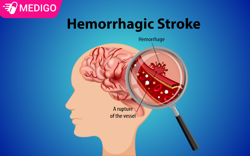 Nguy Cơ Đột Quỵ Cao: 4 Dấu Hiệu "Thầm Lặng" Bạn Không Thể Bỏ Qua