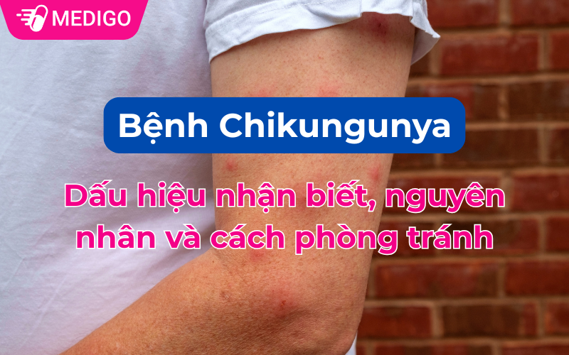 Bệnh Chikungunya: Dấu hiệu nhận biết, nguyên nhân và cách phòng tránh
