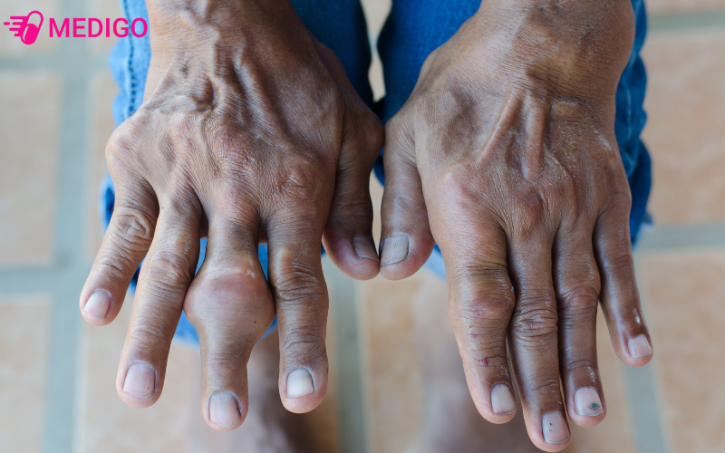 Benh-gout-lau-ngay-gay-anh-huong-nghiem-trong-khop