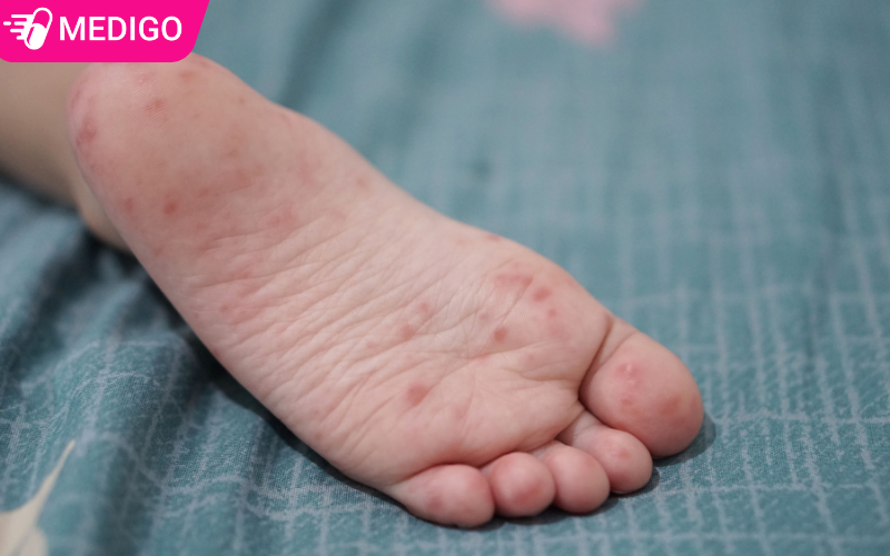 Benh-tay-chan-mieng-rat-pho-bien-o-tre-em