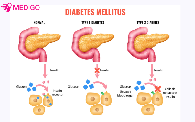 Benh-tieu-duong-duoc-chia-thanh-3-dang