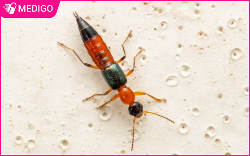 Cách sơ cứu khi bị kiến ba khoang cắn: Hướng dẫn chi tiết nhất 