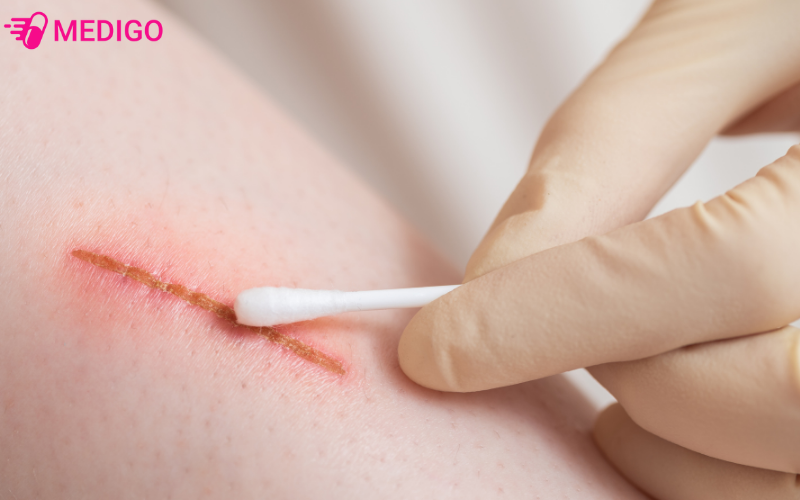 Rau-muong-bien-ho-tro-phuc-hoi-vet-thuong