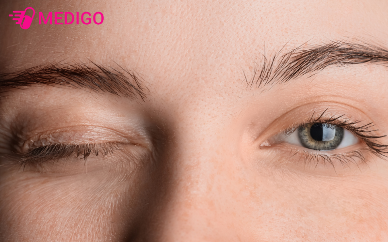 Co-giat-mi-mat-la-hien-tuong-cac-co-vung-mi-xuat-hien-nhung-con-co-that-khong-chu-y