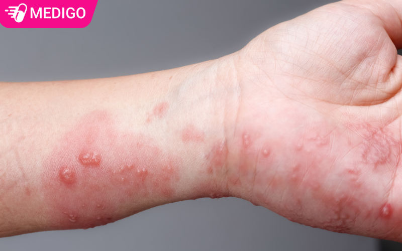 Kem-boi-da-Acyclovir-co-the-dieu-tri-benh-Zona-than-kinh