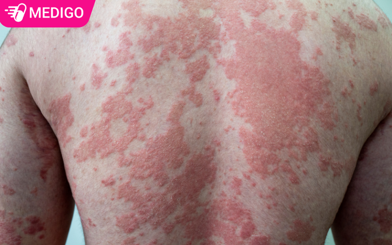 Thuoc-Bethadesmin-con-giup-dieu-tri-benh-vay-nen