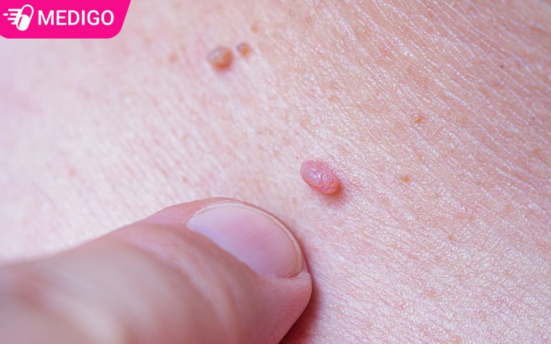 Khi-mac-benh-se-co-cac-not-sui-hoac-u-nhu-xuat-hien-o-co-the