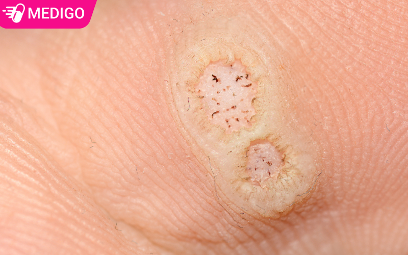 Mun-coc-xuat-hien-o-long-ban-chan