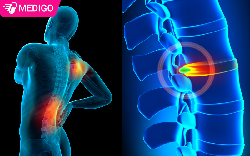 Thoat-vi-dia-dem-thuong-xuat-hien-o-vung-co-va-vung-lung