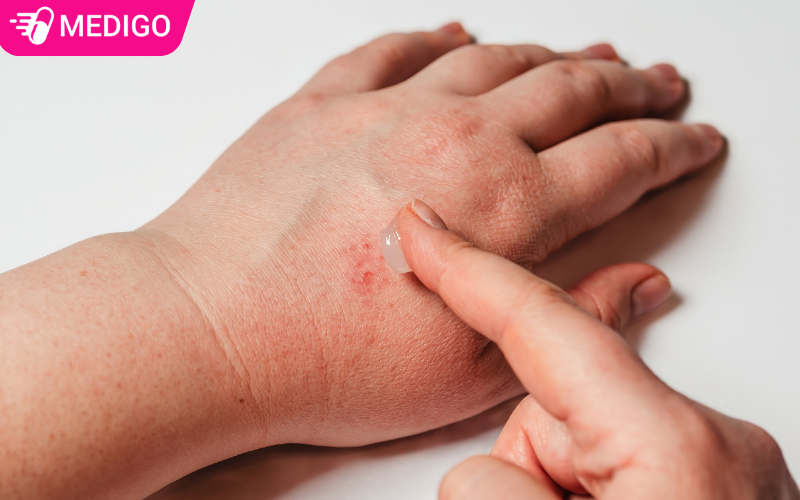 Sau-khi-boi-thuoc-ban-nen-rua-sach-tay-de-tranh-boi-len-cac-vung-khac