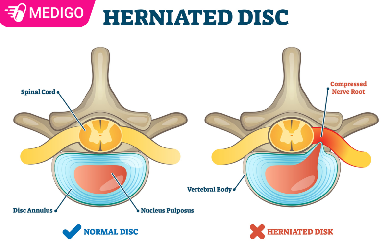 Thoat-vi-dia-dem-la-tinh-trang-nhan-nhay-ben-trong-dia-dem-thoat-ra-ngoai-qua-vet-rach-o-bao-xo