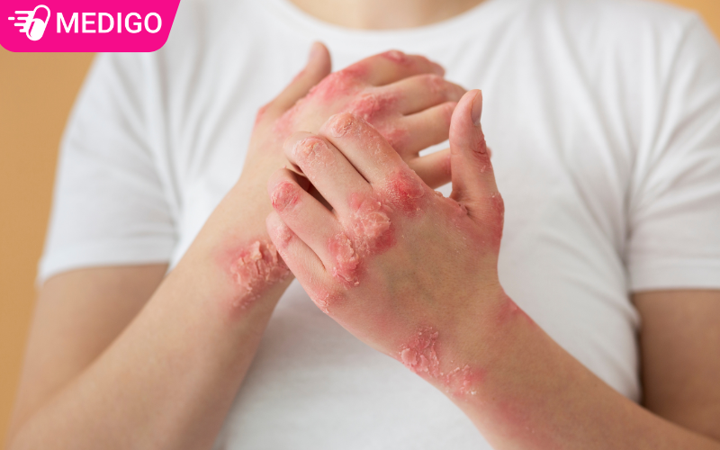 Viêm da cơ địa: Không chỉ là ngứa – mà là lời cảnh báo bạn đang bỏ lỡ điều gì đó