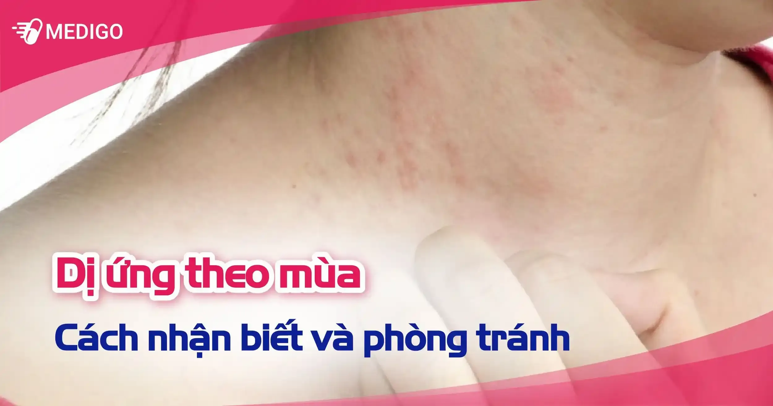 Dị ứng theo mùa: Nhận biết và phòng tránh