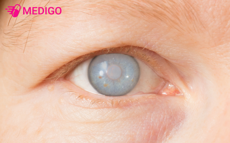 Duc-thuy-tinh-the-la-tinh-trang-thuy-tinh-the-trong-suot-cua-mat-bi-mo-duc