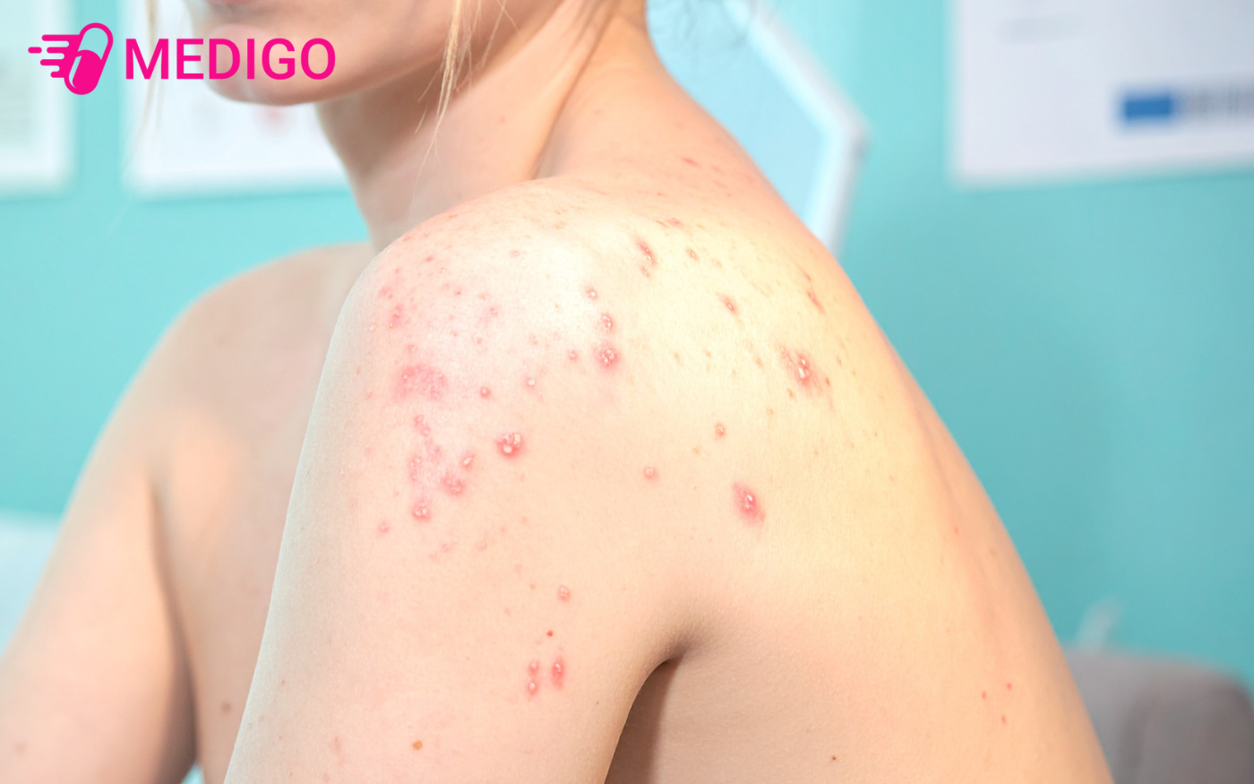 Gynofar-500ml-cung-duoc-dung-cho-nhieu-van-de-da-lieu-khac-nhu-rom-say-mun-lung