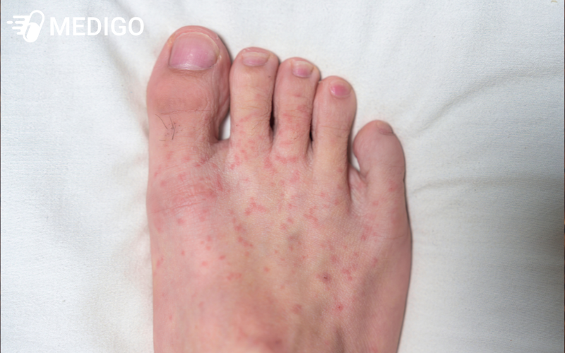 Hinh-anh-nguoi-bi-noi-man-do-phan-ban-chan