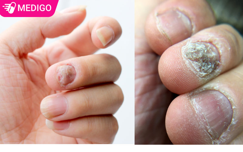 Mot-so-hinh-anh-nam-mong-tay