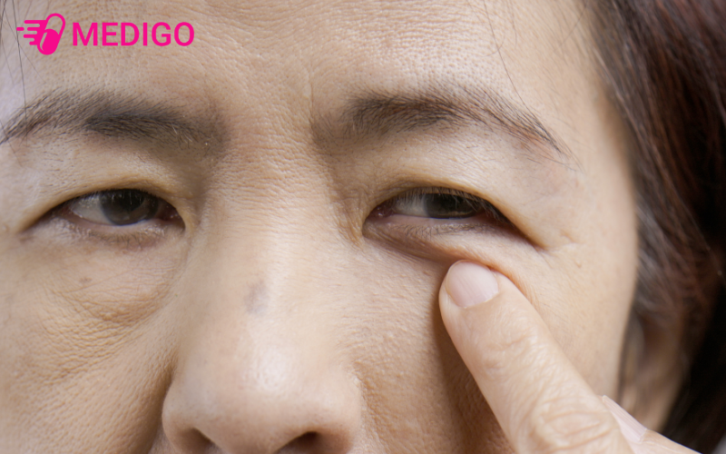 Myokymia-thuong-giat-nhe-thoang-qua-ma-co-the-tu-khoi-