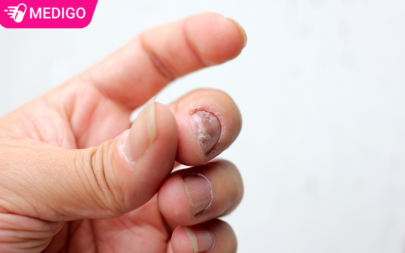 Nấm móng tay: Nguyên nhân, dấu hiệu nhận biết và cách điều trị hiệu quả
