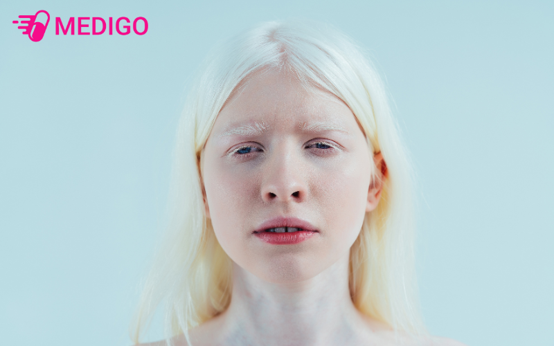 Nguoi-benh-thuong-co-da-nhay-cam-va-de-bi-bong-nang