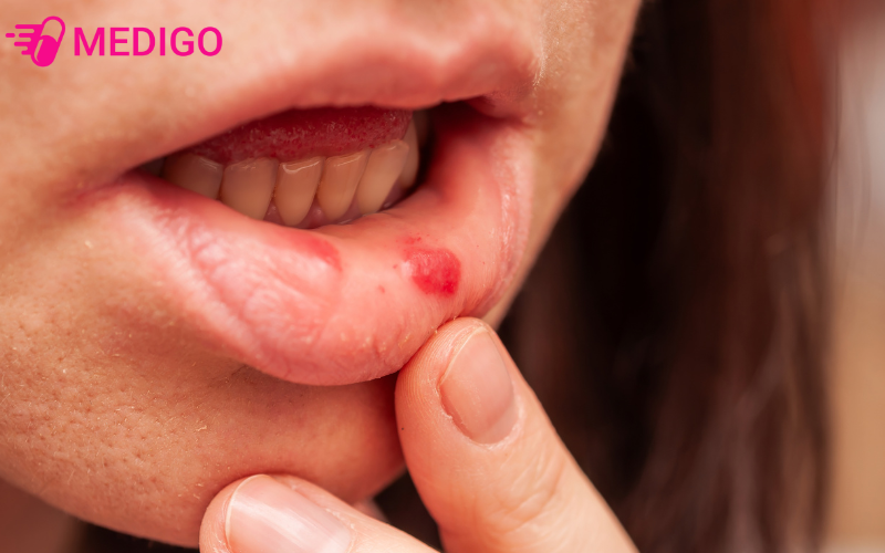 Nguoi-mac-benh-tay-chan-mieng-co-the-bi-cac-vet-loet-nho-