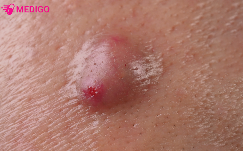 Nguyen-nhan-do-noi-mun-viem-nhot-hoac-ap-xe-vung-kin