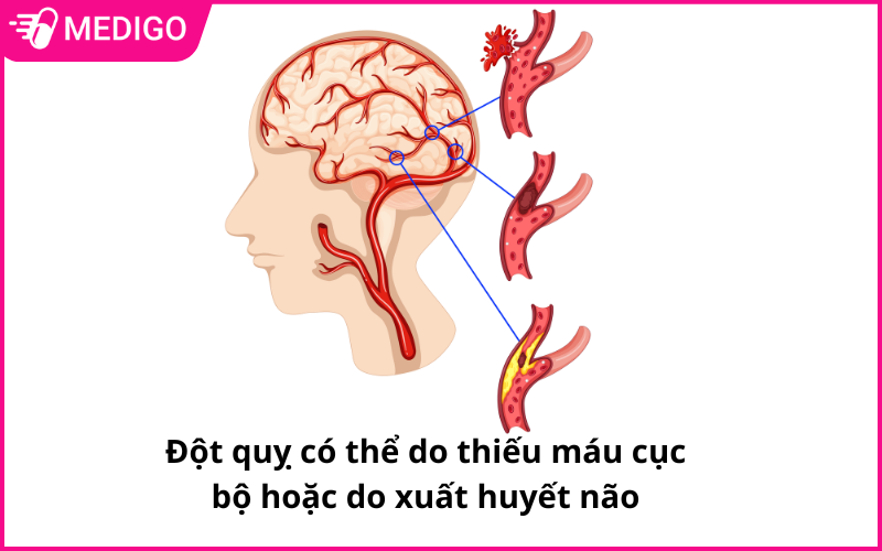 Nguyen-nhan-gay-tai-bien-mach-mau-nao