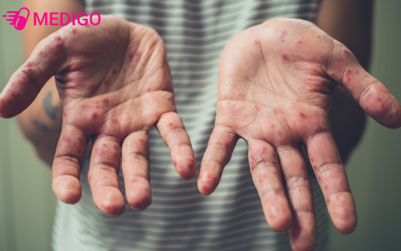 Tay-chan-mieng-chu-yeu-lay-qua-duong-tieu-hoa-