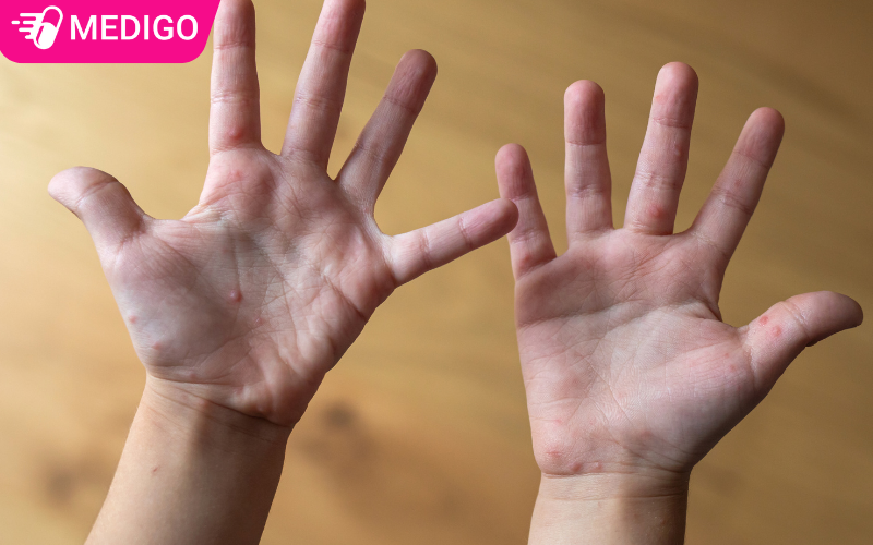 Tay chân miệng có lây không? Dấu hiệu nặng cần nhập viện