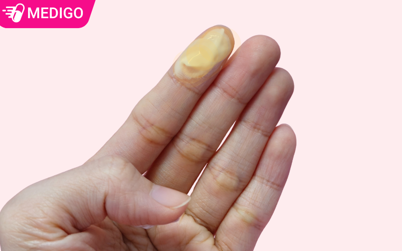 Khí hư màu vàng phải làm sao? 7 việc nên làm
