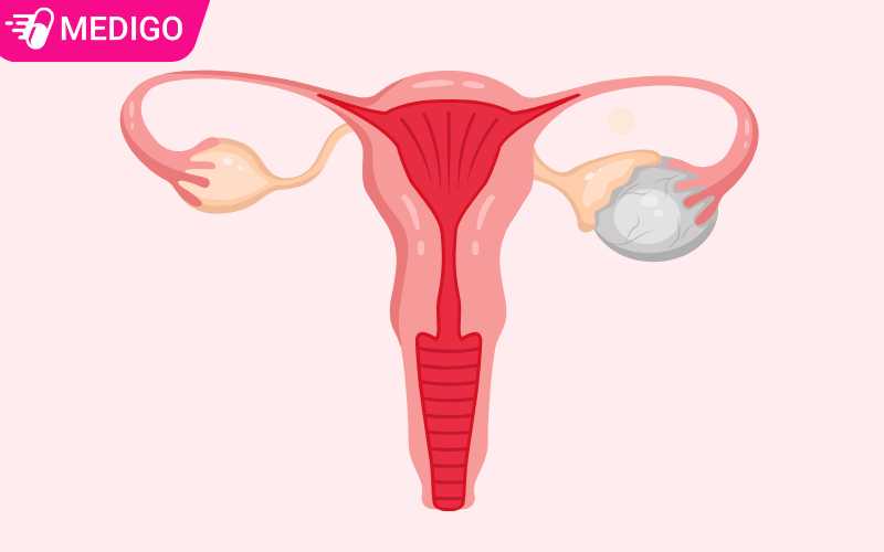 Người bị u nang buồng trứng có uống thuốc tránh thai được không: 5 sự thật