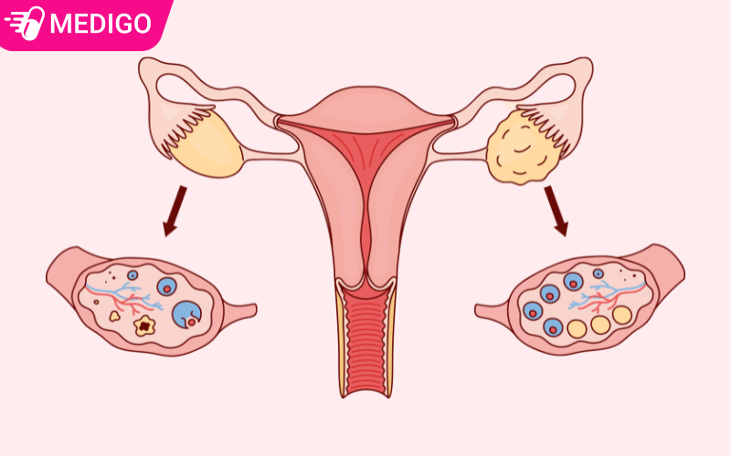 Người bị đa nang buồng trứng có uống thuốc tránh thai được không: 3 lưu ý