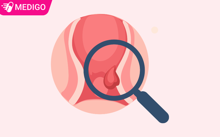 Ra máu sau quan hệ do polyp cổ tử cung: 4 trường hợp cần điều trị