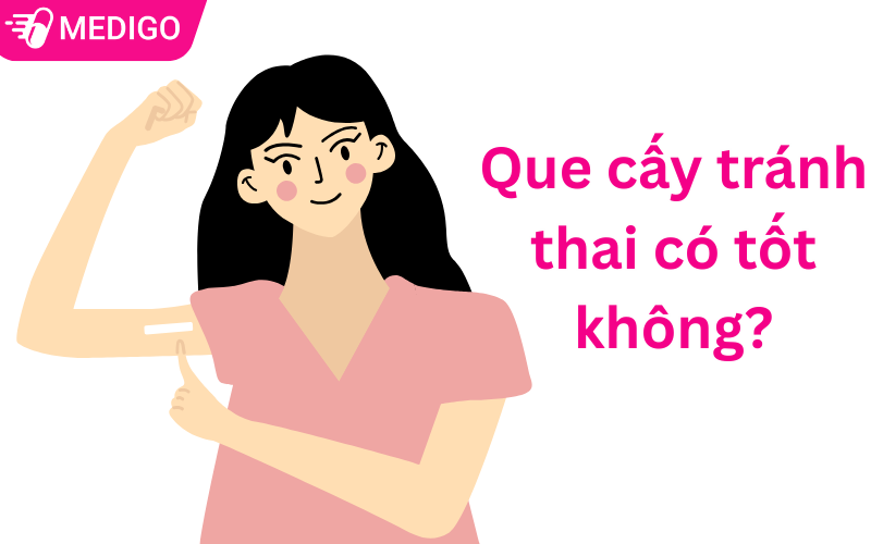 Que cấy tránh thai có tốt không: Ưu và nhược điểm cần biết